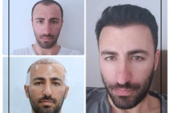 hair-transplant-before-after-nimclinic-400x400-1