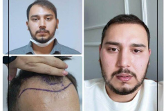 nimclinic-hair-transplant-before-after-turkey-10-600x600
