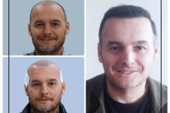 nimclinic-hair-transplant-before-after-turkey-13-600x600