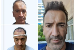 nimclinic-hair-transplant-before-after-turkey-16-400x400
