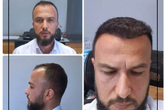 nimclinic-hair-transplant-before-after-turkey-4-600x600