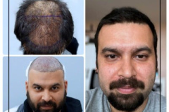 nimclinic-hair-transplant-before-after-turkey-400x400