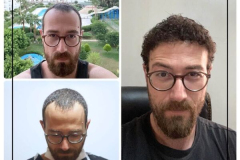 nimclinic-hair-transplant-before-after-turkey-5-600x600