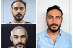 nimclinic-hair-transplant-before-after-turkey-6-400x400