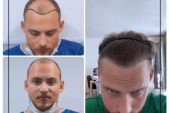 nimclinic-hair-transplant-before-after-turkey-7-600x600