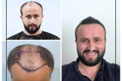 nimclinic-hair-transplant-before-after-turkey-9-600x600