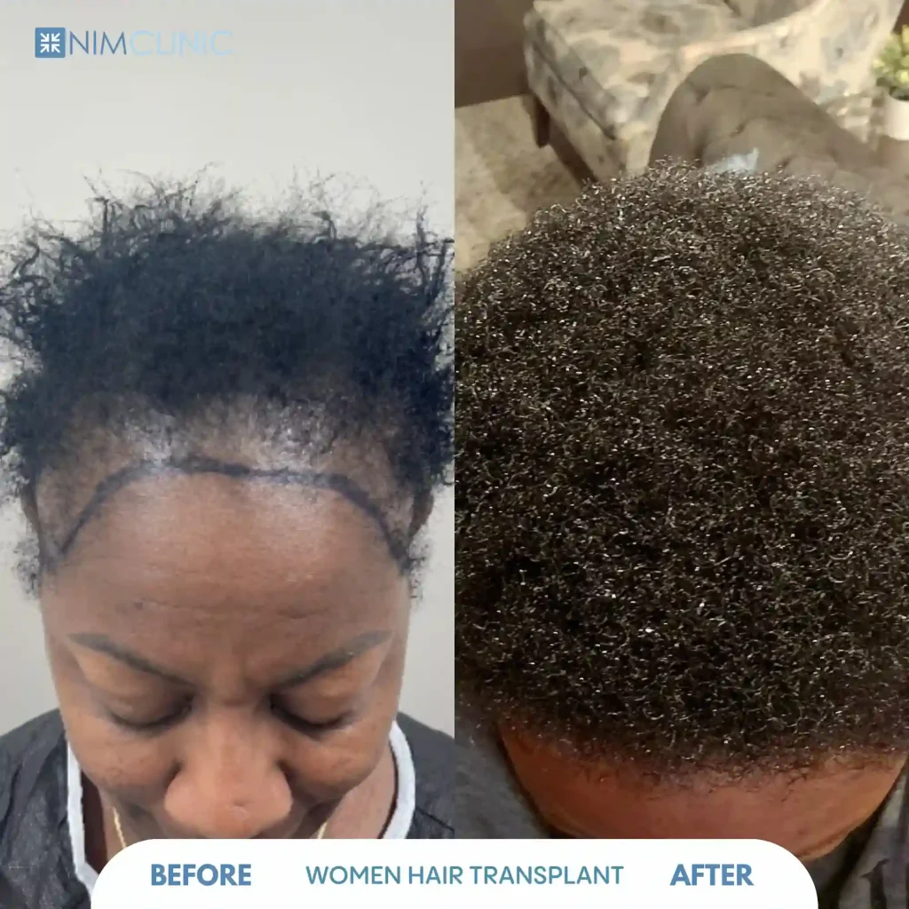 women hair transplant before after