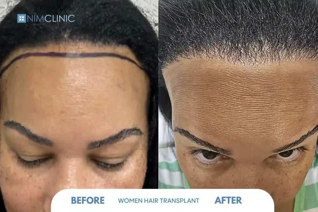 women hair transplant in turkey result